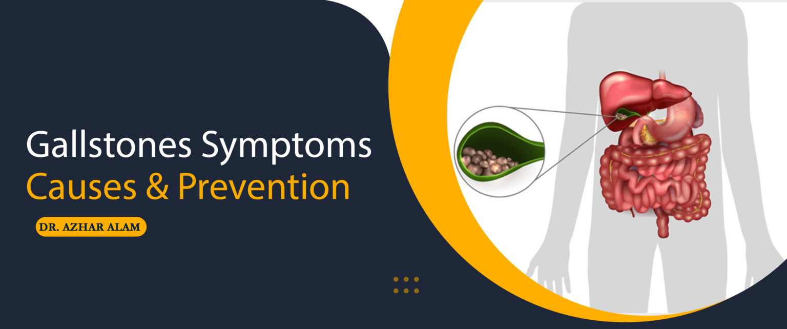 Gallstones Symptoms Causes Prevention Gallstone Specialist   Gallstones Symptoms Causes Prevention 1 1536x642 