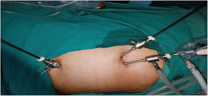 Cholecystectomy Surgery