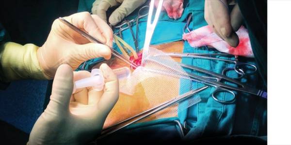 Laparoscopic Treatment