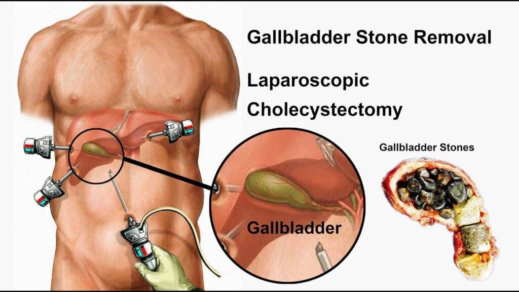 remove gallbladders