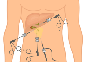laparoscopic-cholecystectomy
