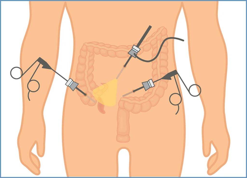 procedure-lapriscopic-appendectomy