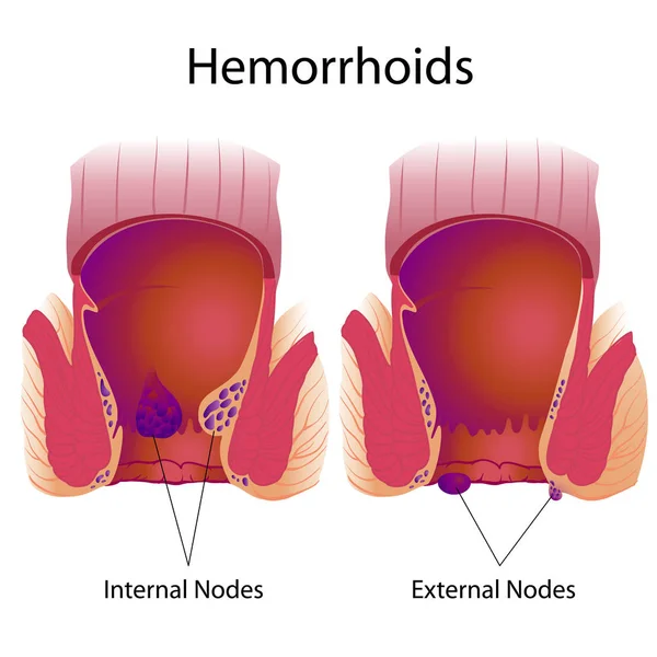 Different types of hemorrhoids