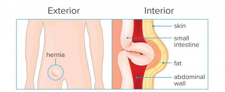 Hernia interior & exterior