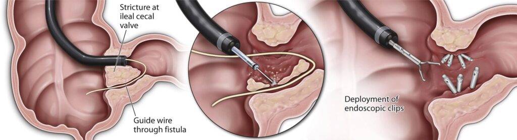 Fistulotomy