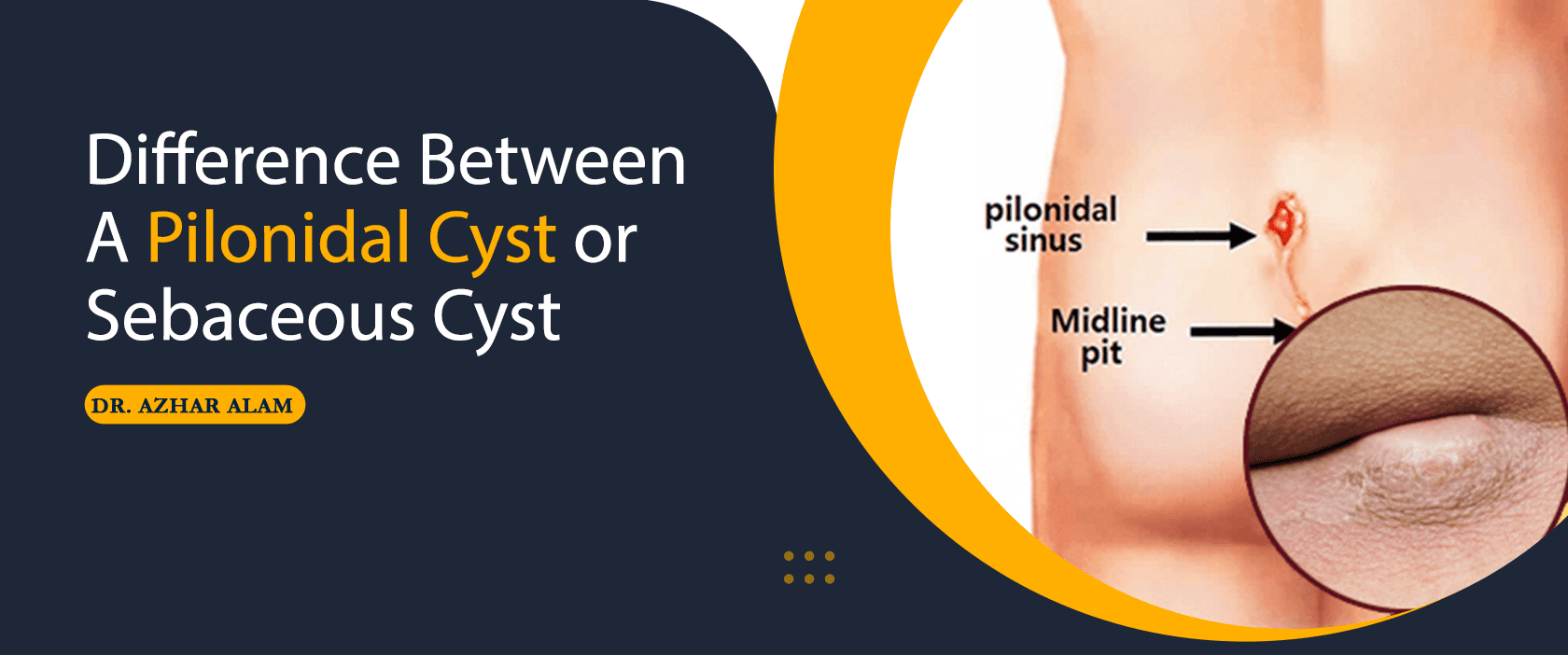Difference Between A Pilonidal or Sebaceous Cyst