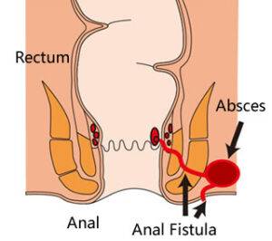 Anal Fistula