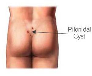 pilo-cyst