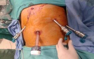 Hernia Surgery