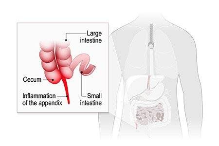 What-is-appendicitis