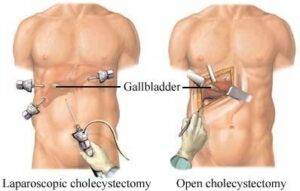 laparoscopic-cholecystectomy