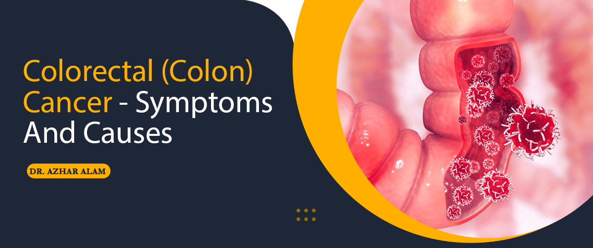 Colorectal (Colon) Cancer - Symptoms And Causes